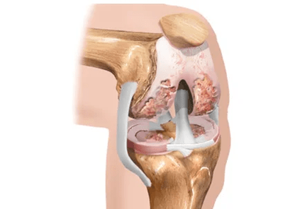The differences in arthritis or arthritis