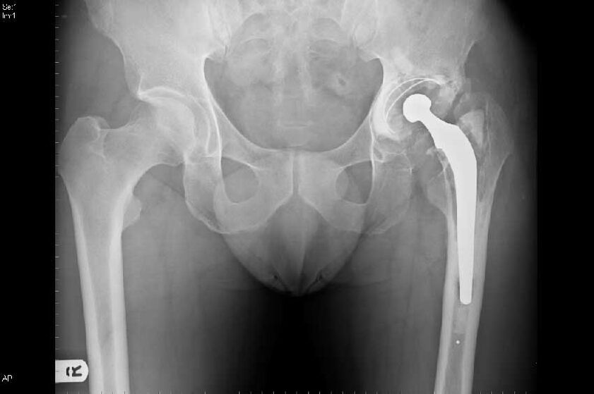 Cocsartrosis
