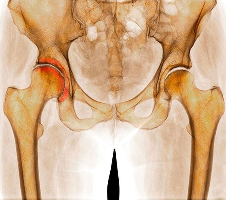 The hip joint is a joint joint