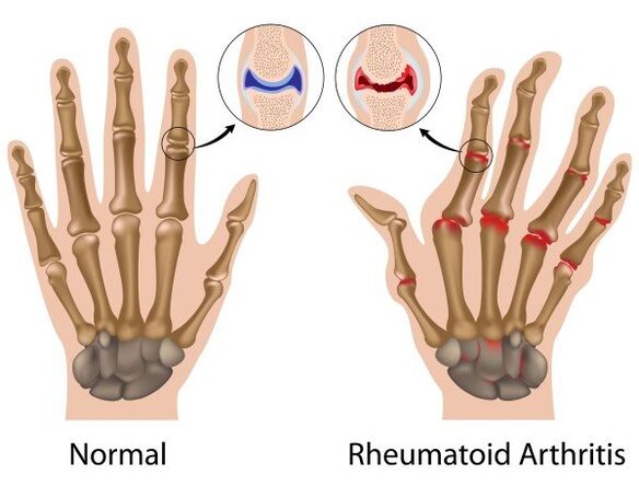 Finger joints without pathology and rheumatoid arthritis