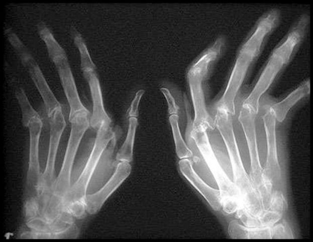 Image of hands affected by X -arthrosis