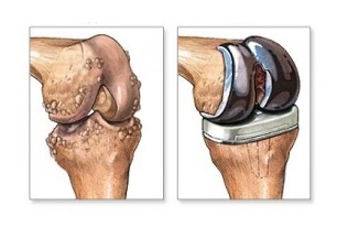 knee replacement in case of arthrosis