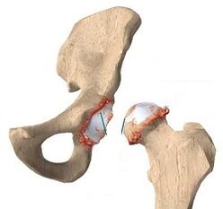 Causes of the formation of arthrosis of the hip joint