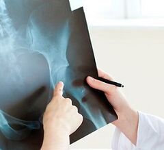 How to treat the hip joint Arthross