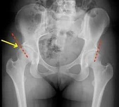 Methods for treating arthrosis of the hip joint