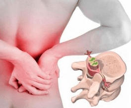 Lumbago the disease at the beginning of osteochondrosis