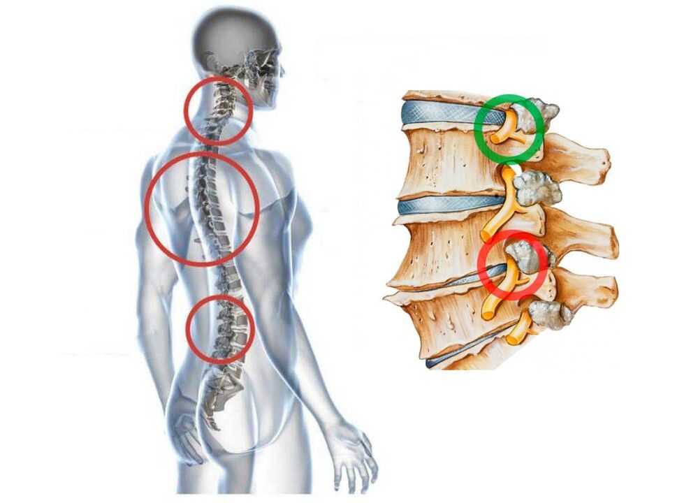 How does the vertebrae look cervical osteochondrosis