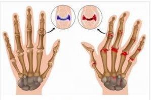 Differences between arthritis and joints of the hands