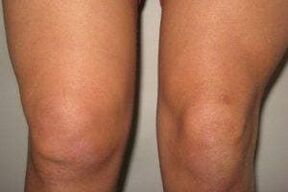 Inflammation in the knee joint with arthritis and arthrosis