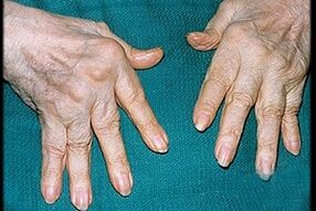 Symptoms of arthritis in fingers