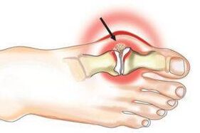 arthritis due to arthritis and arthrosis