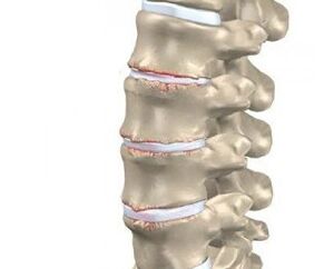 development of osteochondrosis of the spine