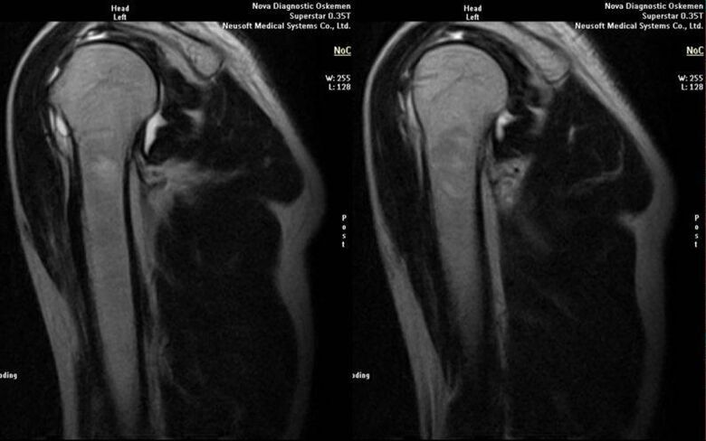 arthrosis of the shoulder joint on X-ray
