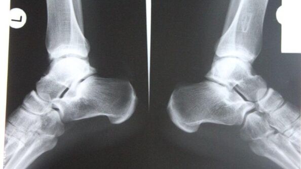 Diagnosing arthrosis of the ankle using radiography
