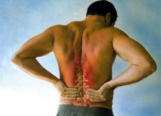 Pain due to lumbar osteochondrosis